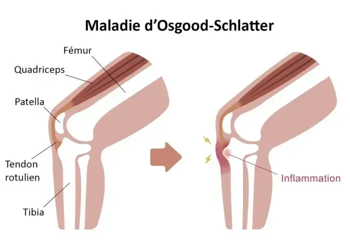 Les maladies de croissance chez l’enfant : maladie de Sever et Osgood-Schlatter