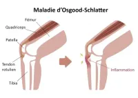 osgood schlatter