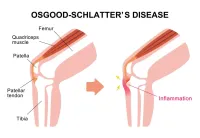osgood schlatter (1)