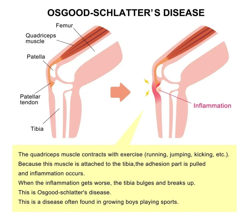 osgood schlatter (3)