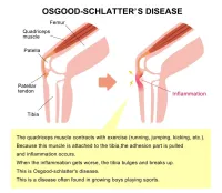 osgood schlatter (3)