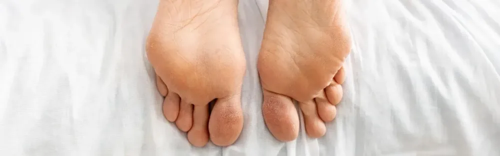 Pieds secs et crevasses : causes et solutions