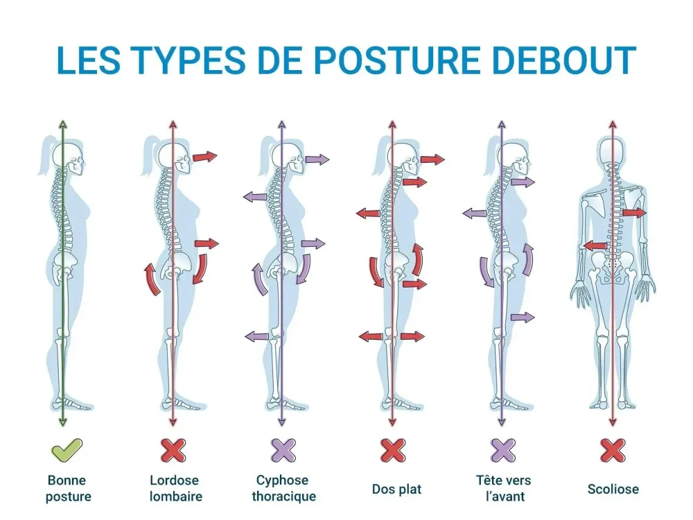 Sciatique et podologie : prévenir, comprendre et éviter l’opération ; Qu’est-ce que la sciatique ?
