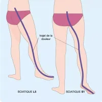sciatique (2)