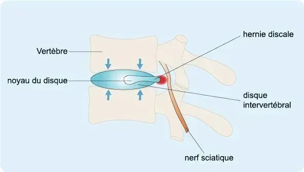 sciatique (2)