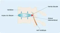 sciatique (2)
