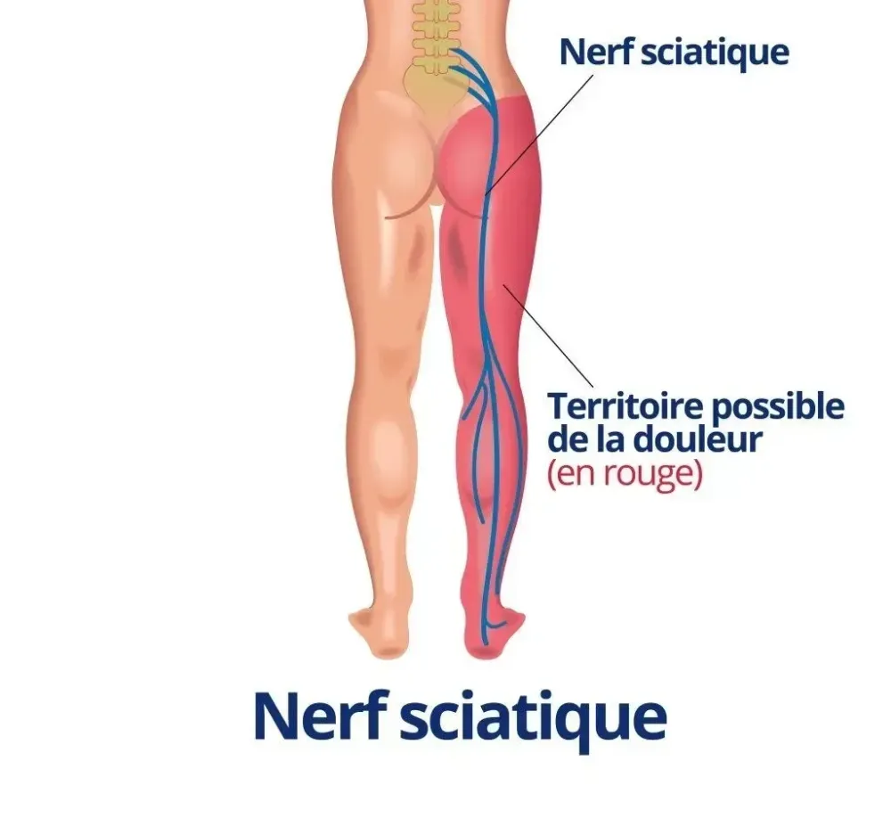 sciatique (3)