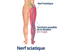 sciatique (3)