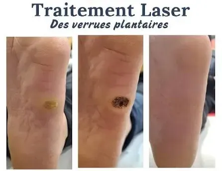 LASER verrue.webp